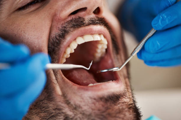 Best Emergency Dentist for Lost Fillings or Crowns in Havelock, NC